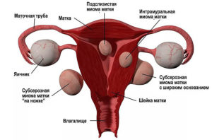 Что делать если миома матки растет