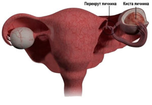 Перекрут кисты яичника симптомы