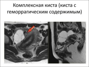 Геморрагическая киста яичника