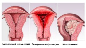 Гиперплазия эндометрия при климаксе симптомы и лечение