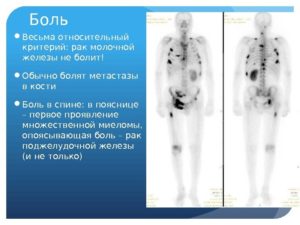 Рак молочной железы симптомы и признаки на ранних фото