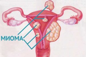 Миома и фибромиома в чем разница