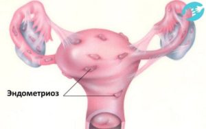 Можно ли париться при эндометриозе матки
