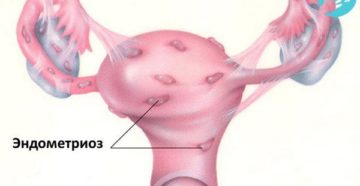 Можно ли париться при эндометриозе матки