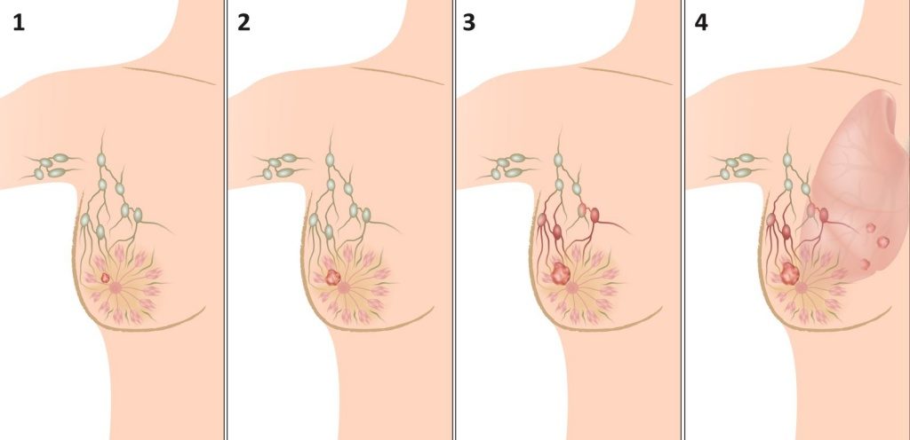 Первая стадия рака молочной железы