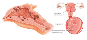 Внутренний эндометриоз матки