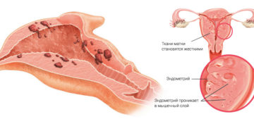 Внутренний эндометриоз матки