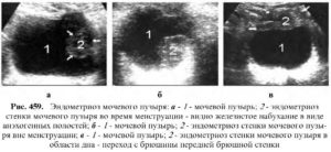Эндометриоз мочевого пузыря симптомы лечение