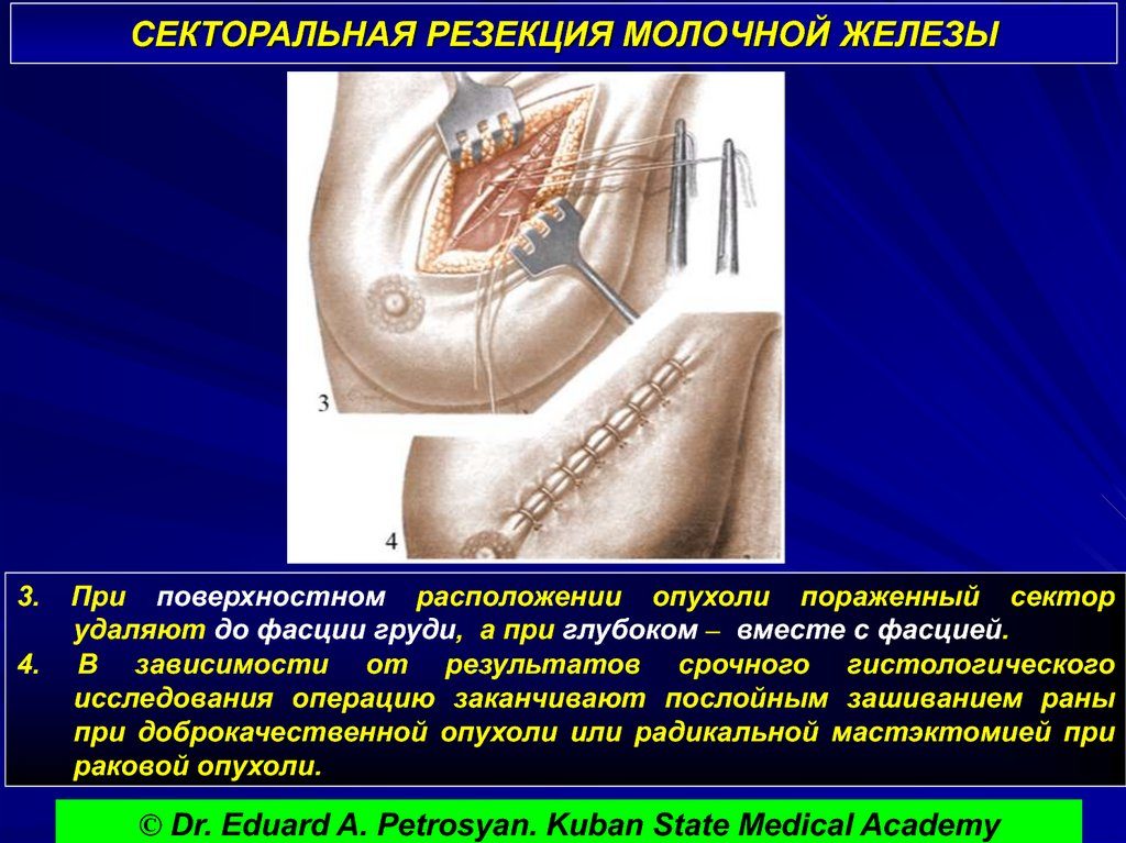 Секторальная резекция молочной железы техника операции