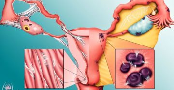 Хронический эндометриоз симптомы и лечение