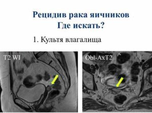 Рецидив рака яичников