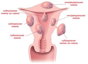 Миома интрамуральная и беременность