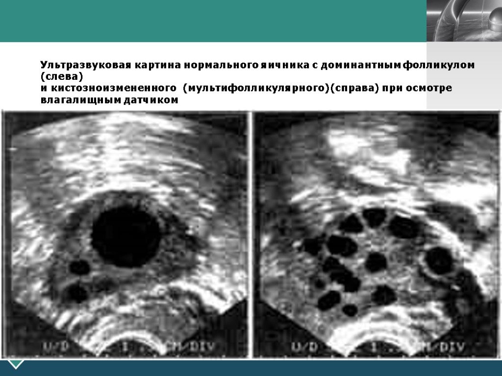 Доминантный фолликул в правом яичнике