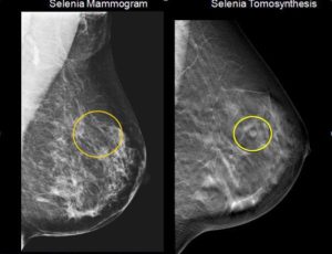 Что эффективнее узи или маммография молочных желез