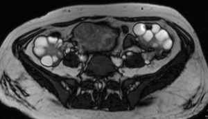 Что показывает мрт яичников