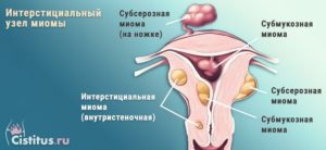 Интерстициальный узел миома