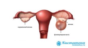 Фолликулярная киста яичника задержка месячных