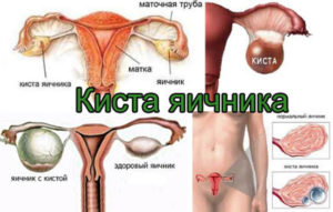 Киста яичника симптомы и лечение женщины народными средствами