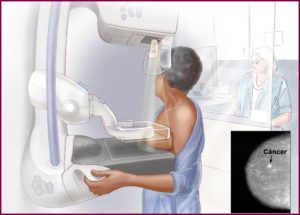 Как проводится маммография молочных желез