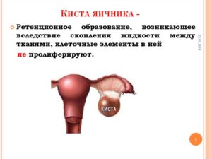 Ретенционное образование правого яичника