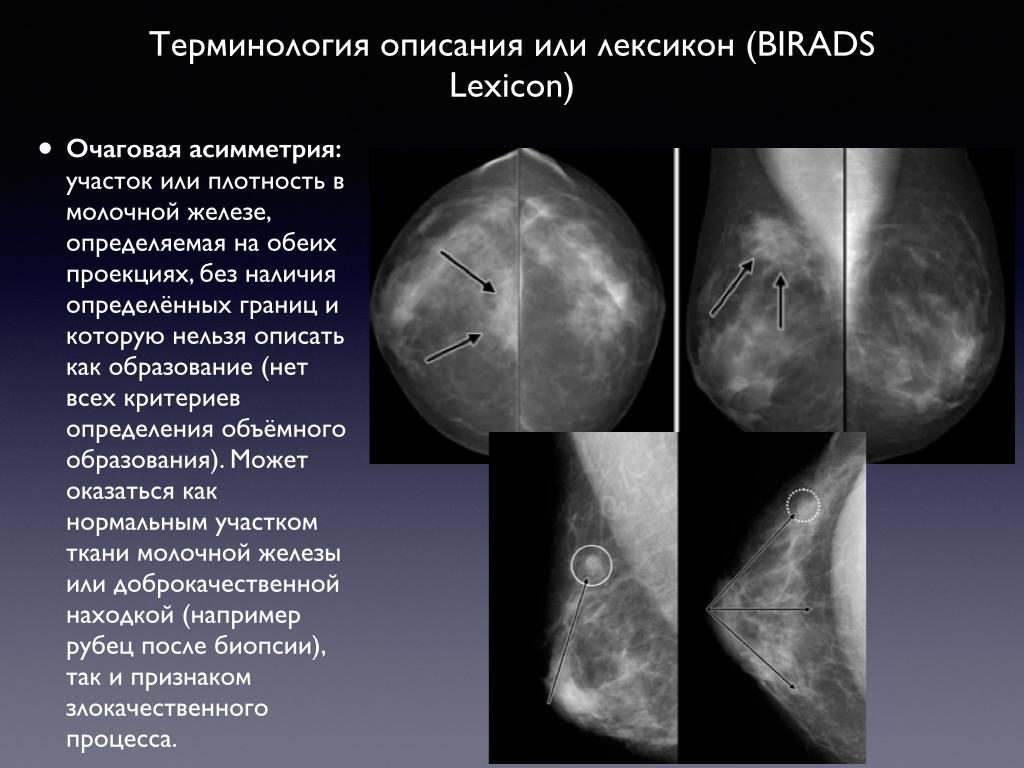 Очаговая асимметрия молочной железы