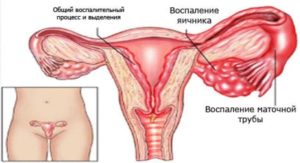 Симптомы воспаления придатков и яичников у женщин