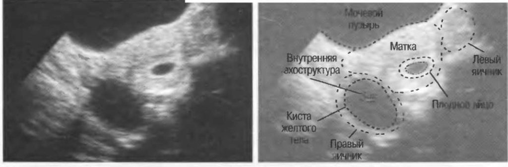 Киста правого яичника желтого тела при беременности на ранних сроках