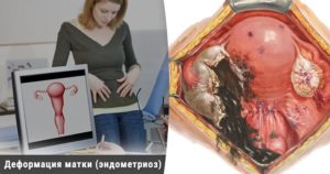Эндометриоз прямой кишки