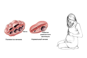 Поликистозные яичники и беременность