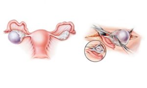 Киста яичника в период менопаузы