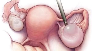 Киста левого яичника при беременности