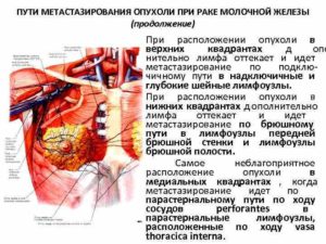 Метастазы в лимфоузлах при раке молочной железы прогноз