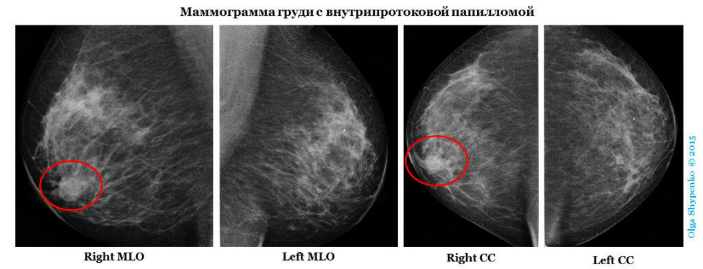 Цистаденома молочной железы