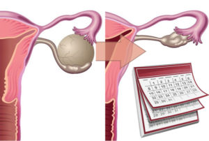 Может ли киста яичника рассосаться сама