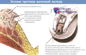 Дуктэктазия молочной железы лечение