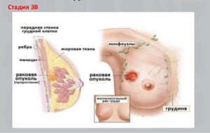 Третья стадия рака молочной железы
