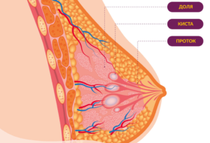 Виды кист молочной железы