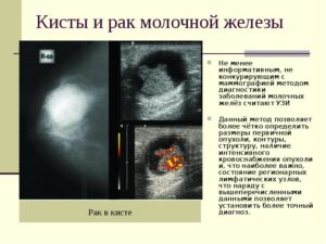 Может ли киста молочной железы перерасти в рак