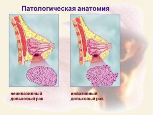 Патанатомия рак молочной железы