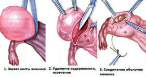 Профилактика кисты яичника