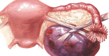 Лечение фиброма яичника
