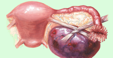 Кровотечение при кисте яичника