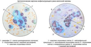 Анализ выделений молочных желез