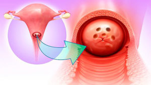 Лечение эндометриоза шейки матки