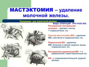 Операция по удалению рака молочной железы