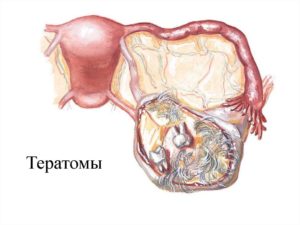 Тератома яичника что это такое у женщин