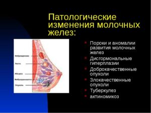 Гиперплазия молочных желез у женщин