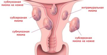 Интрамуральная миома матки