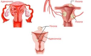 Аденомиоз и миома матки это одно и тоже