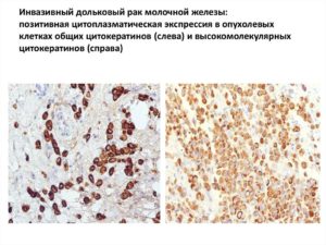 Инвазивный дольковый рак молочной железы 2 степени злокачественности